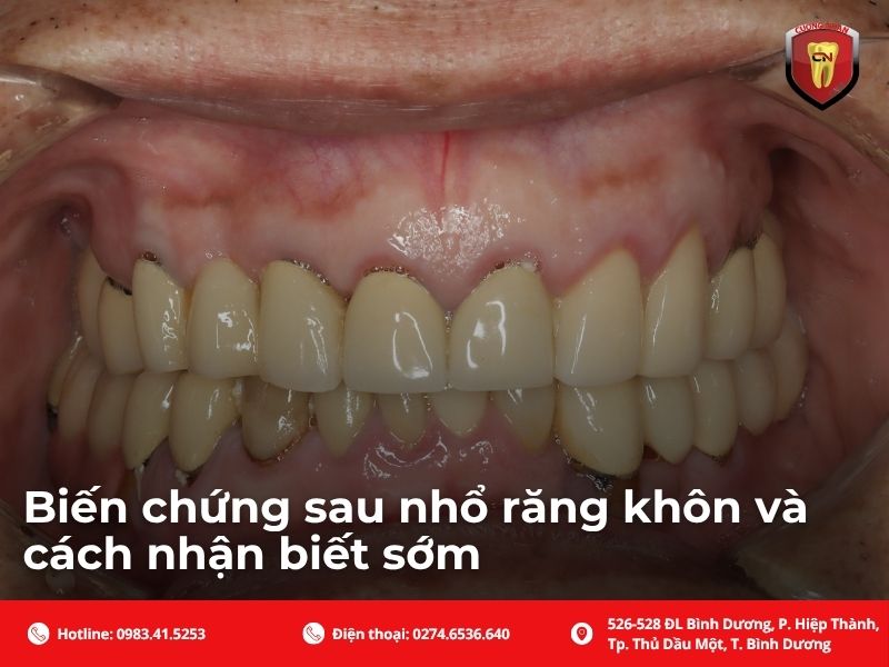 Biến chứng sau nhổ răng khôn và cách nhận biết sớm