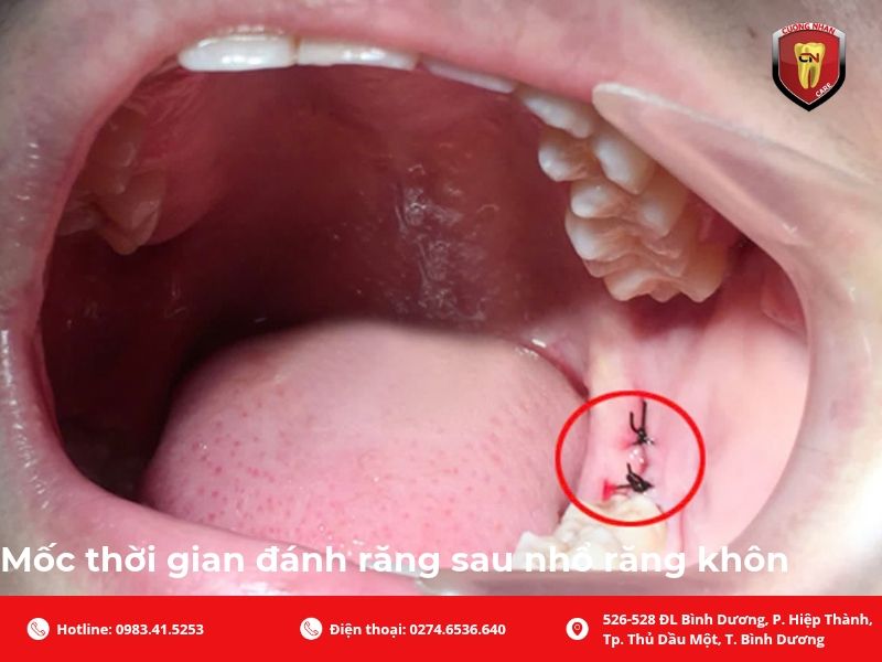 Mốc thời gian đánh răng sau nhổ răng khôn