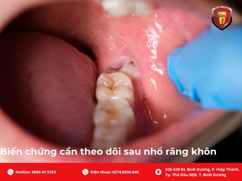 Biến chứng cần theo dõi sau nhổ răng khôn