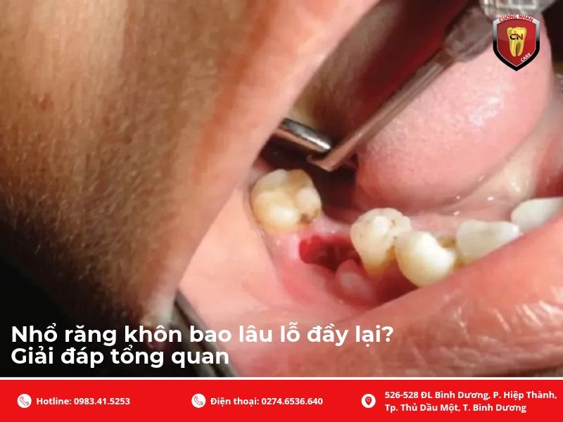 Nhổ răng khôn bao lâu lỗ đầy lại? Giải đáp tổng quan