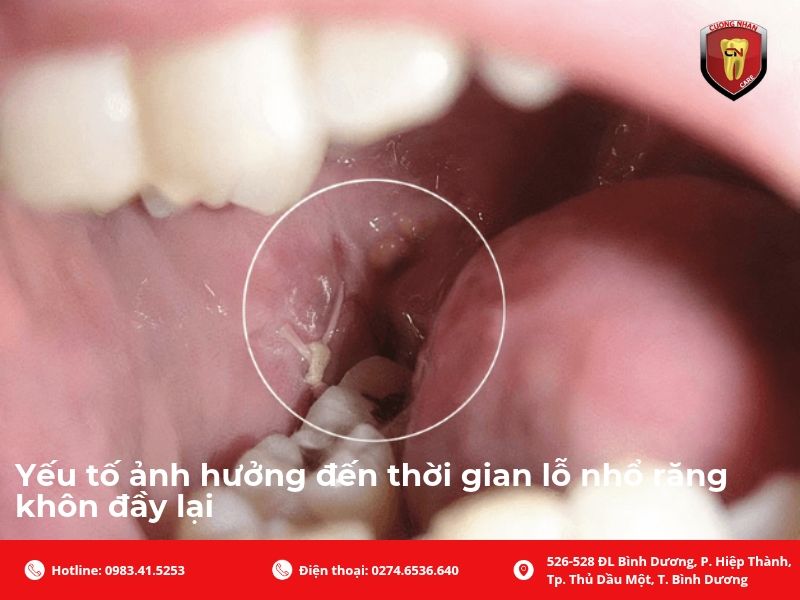 Yếu tố ảnh hưởng đến thời gian lỗ nhổ răng khôn đầy lại