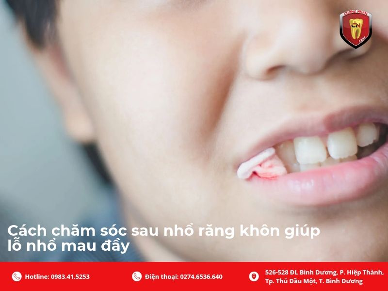 Cách chăm sóc sau nhổ răng khôn giúp lỗ nhổ mau đầy
