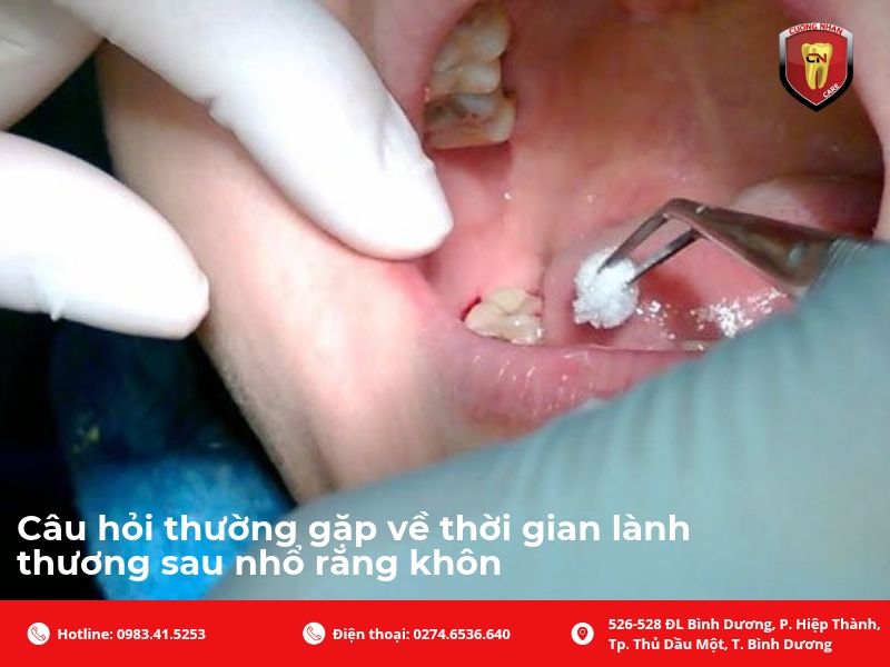 Câu hỏi thường gặp về thời gian lành thương sau nhổ răng khôn
