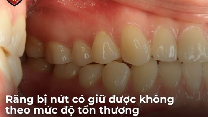 Răng Bị Nứt Có Giữ Được Không? Cách Xử Lý Bảo Tồn An Toàn Khi Bị Nứt