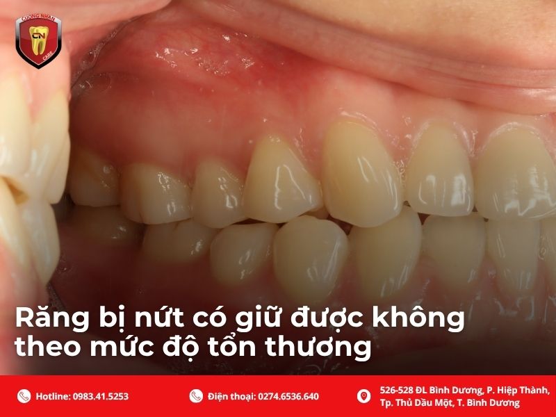 Răng bị nứt có giữ được không theo mức độ tổn thương?