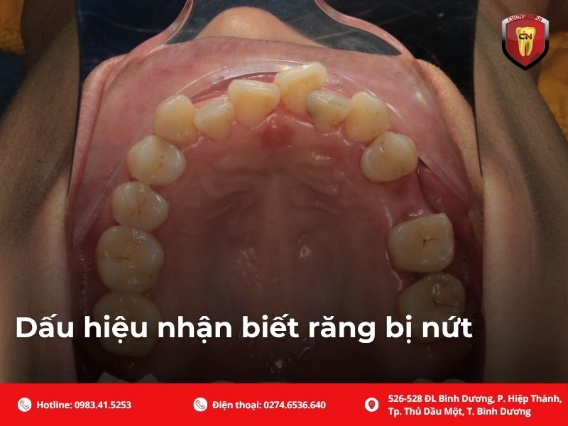 Dấu hiệu nhận biết răng bị nứt