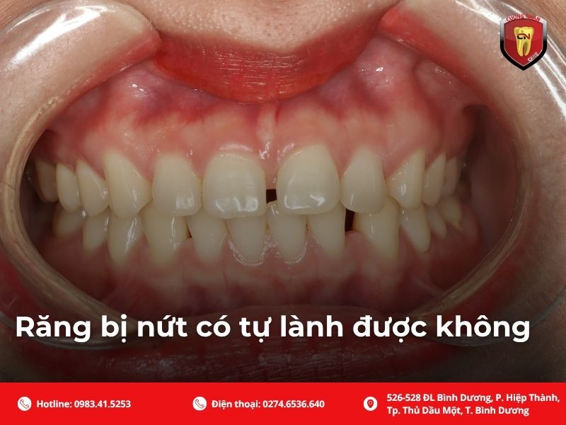 Răng bị nứt có tự lành được không?