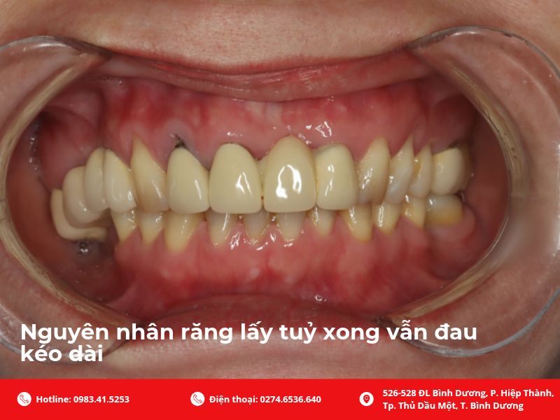 Nguyên nhân răng lấy tuỷ xong vẫn đau kéo dài