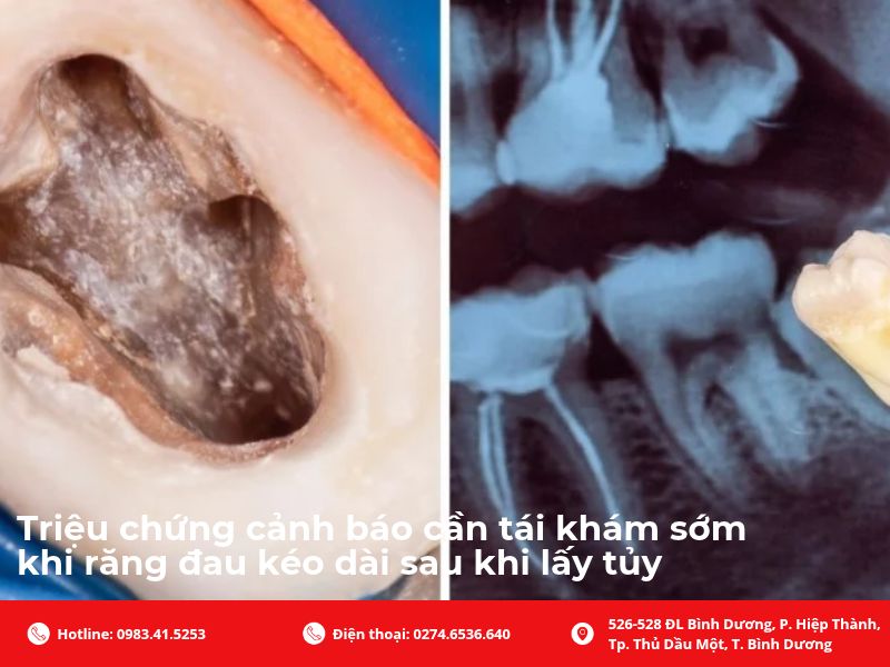 Triệu chứng cảnh báo cần tái khám sớm khi răng đau kéo dài sau khi lấy tủy